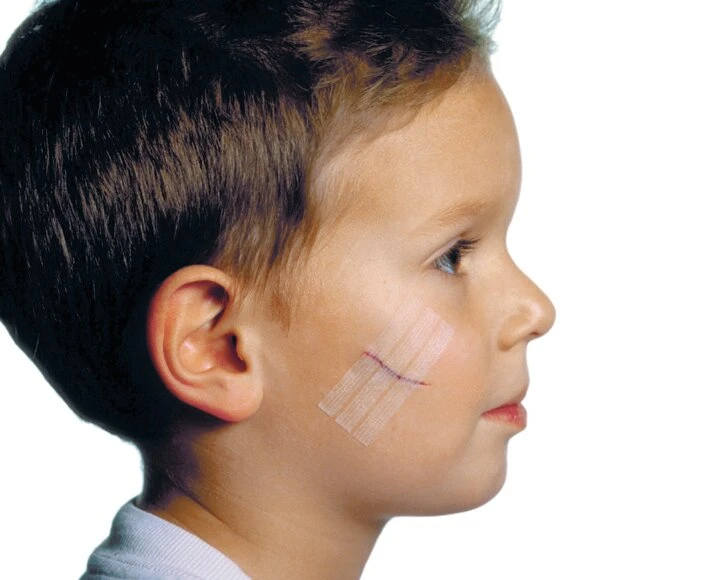 Suture 3M™ STERI-STRIP™